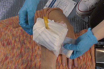 FREMDKÖRPER IN WUNDE